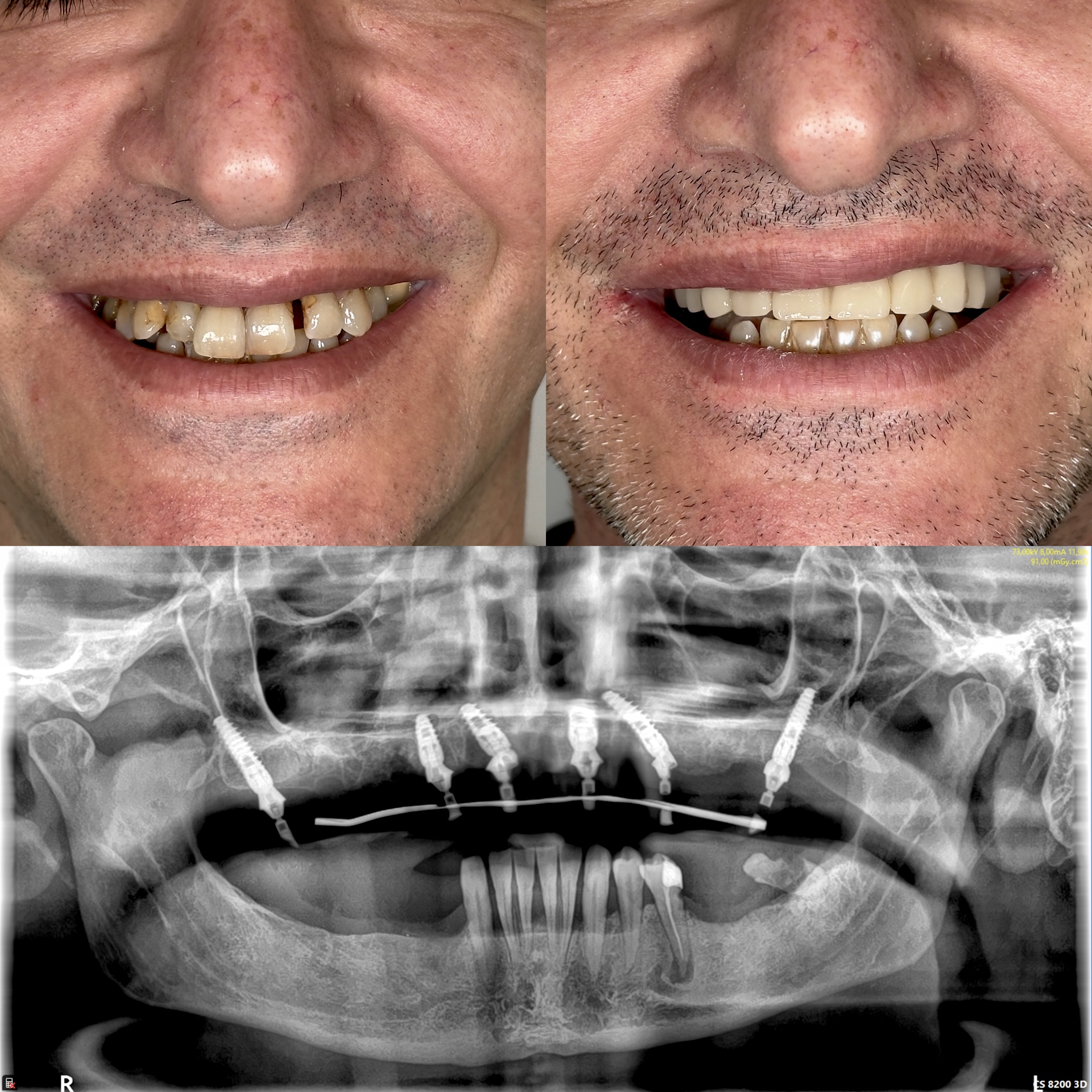 Riabilitazione implantare completa dell’arcata superiore, prima e dopo