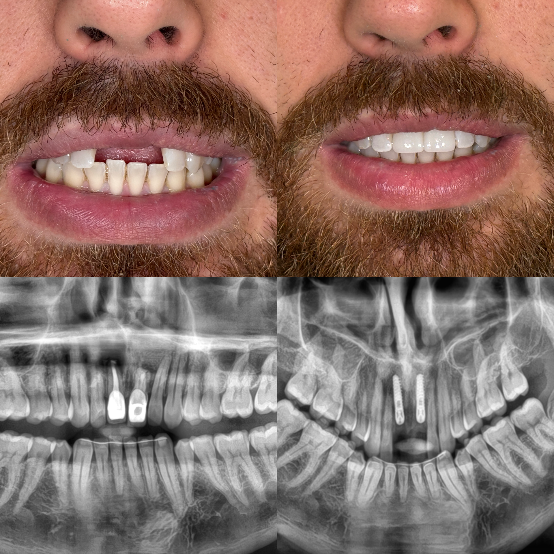 Riabilitazione implantare degli incisivi centrali superiori, prima e dopo